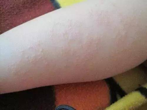 皮肤小腿湿疹的治疗好方法
