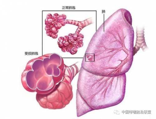 肺大泡的形成与哪些因素有关?日常怎么发现自己患上肺