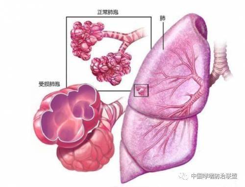 肺大泡与之前分享的慢性肺部疾病,像肺气肿,慢阻肺等一样,是没有办法