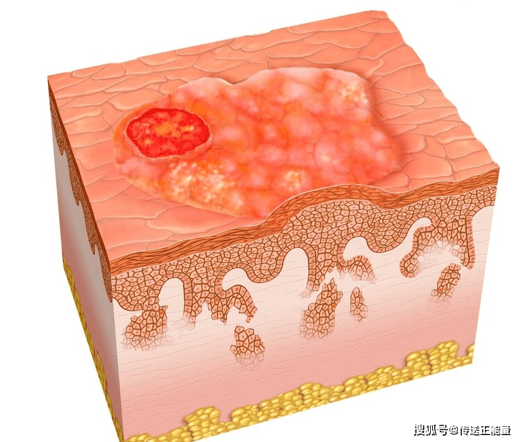 原创体内有癌,皮肤先知!皮肤上的哪些信号,可能说明"癌症"到来?