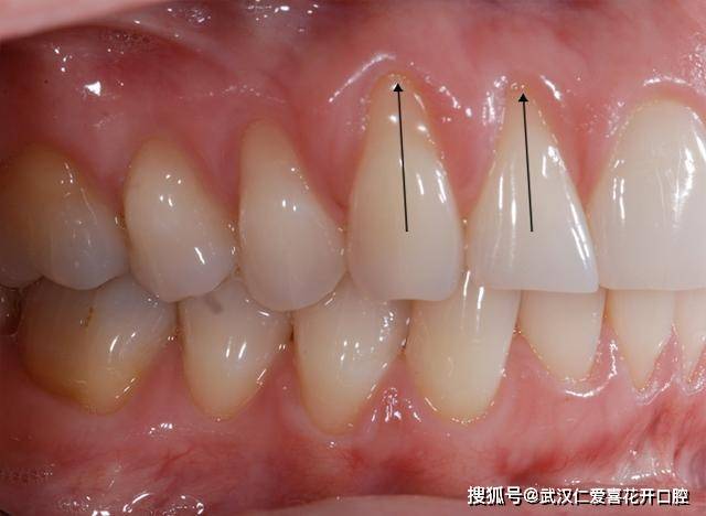牙龈萎缩 指的是牙根部位的牙龈退缩,将牙根曝露出来,所以你的牙齿会