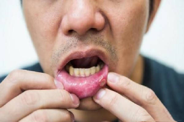 男子口腔溃疡没在意,一个多月后确诊舌癌!医生提醒:这4类人高危