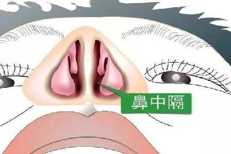 首大陈潜:鼻中隔偏曲术后要注意什么