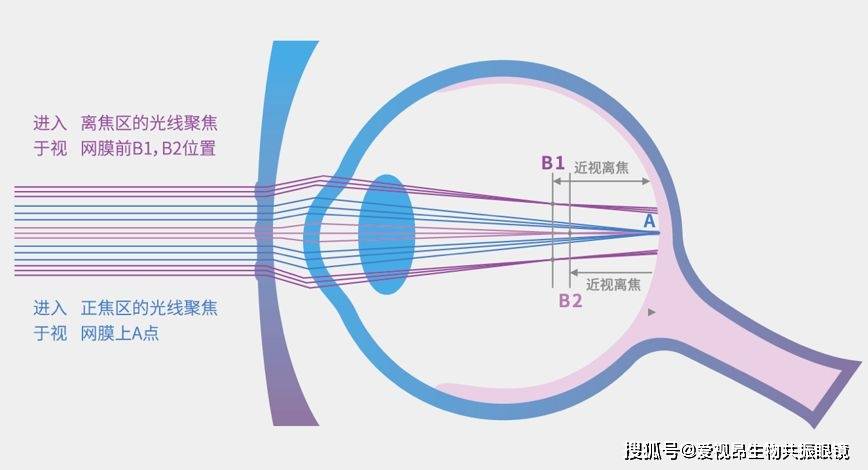 医生:应该矫正避免弱视_眼睛_检查_视力