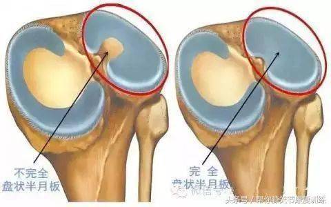 内侧半月板损伤的最好治疗