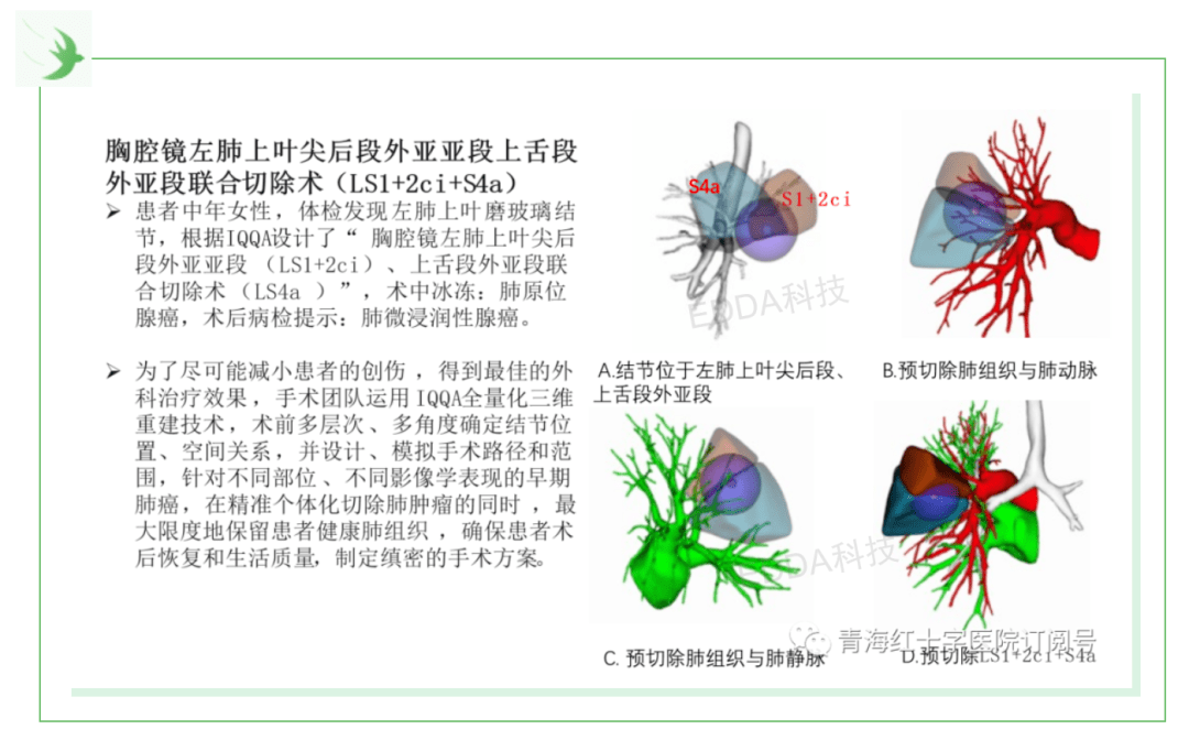 肺段切除相对于楔形切除可以提供更大切除范围已确保肿瘤切缘的安全