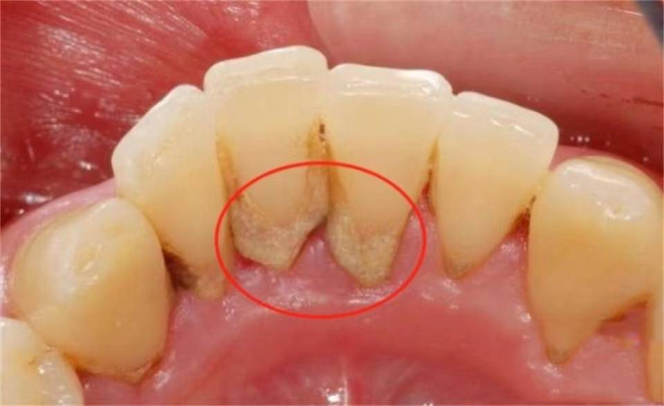 牙结石口臭断根了？那些去口臭办法不平不可，2个月在家口气清爽！