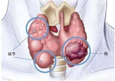 甲状腺结节多发,这种手术竟能不留疤