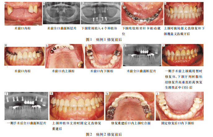 案例分析10例牙齿重度磨损伴牙列缺损种植修复与咬合重建