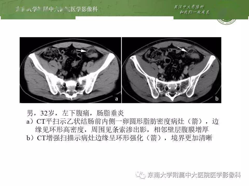 原发性肠脂垂炎