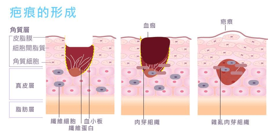 如何判断自己是不是疤痕体质?