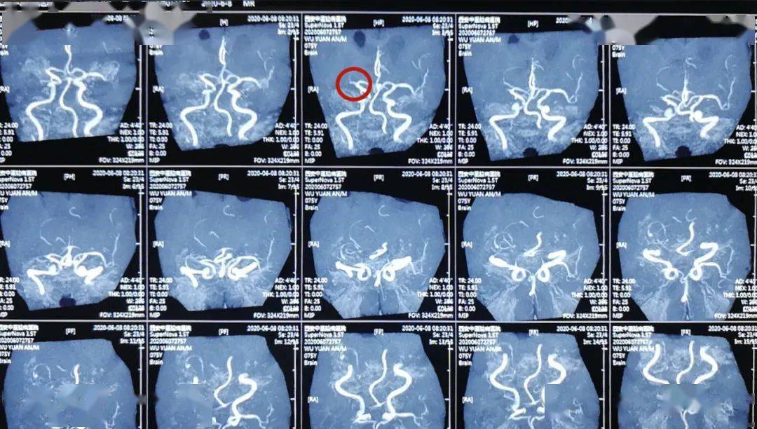此时,核磁共振血管成像显示吴大爷右侧大脑中动脉上干堵塞,已导致