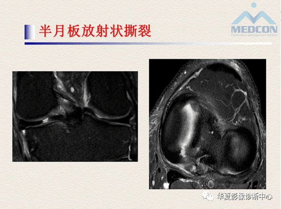 半月板的常见病变及正常变异的核磁共振诊断