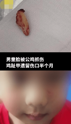 男童被鸡抓伤脸上遗留鸡趾甲，半个月后才发现