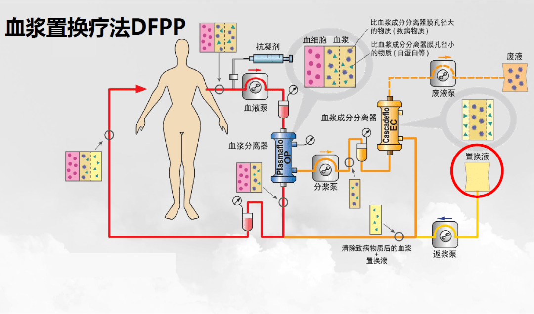 北京市垂杨柳医院成功开展医院首例双重血浆置换技术