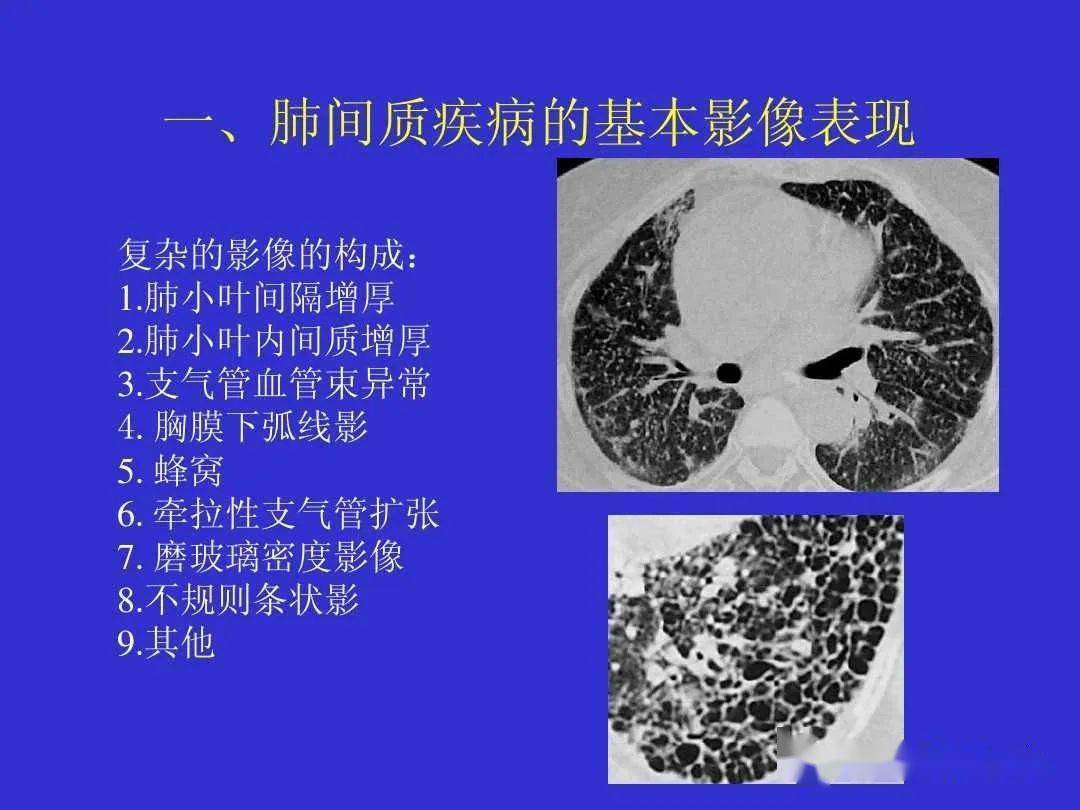 日常工作中间质性肺疾病的影像诊断思路