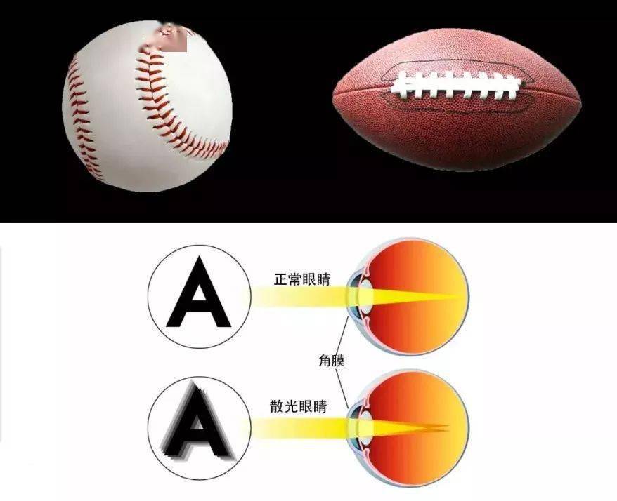 【散光科普】50度的散光,配镜要不要加上?很纠结!