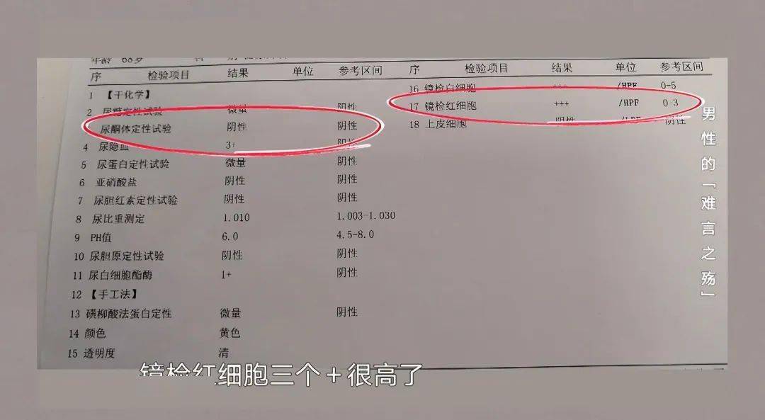尿频,尿急,尿不出,警惕前列腺疾病找上你!