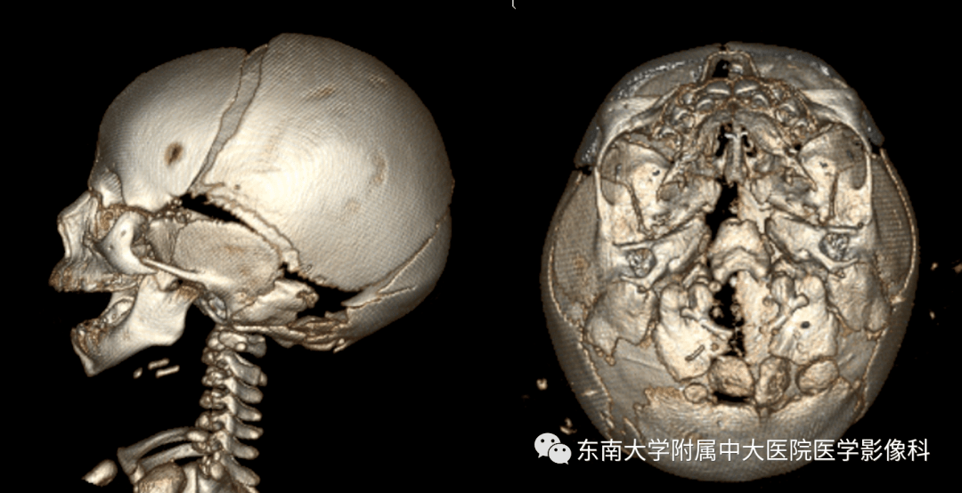 15 肌骨系统疾病—pierre-robin 综合征