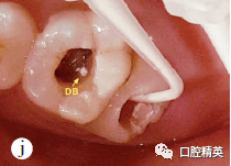 一诊:放置橡皮障,去除7面充填物后探及穿髓孔,7开髓后可见髓室内感染