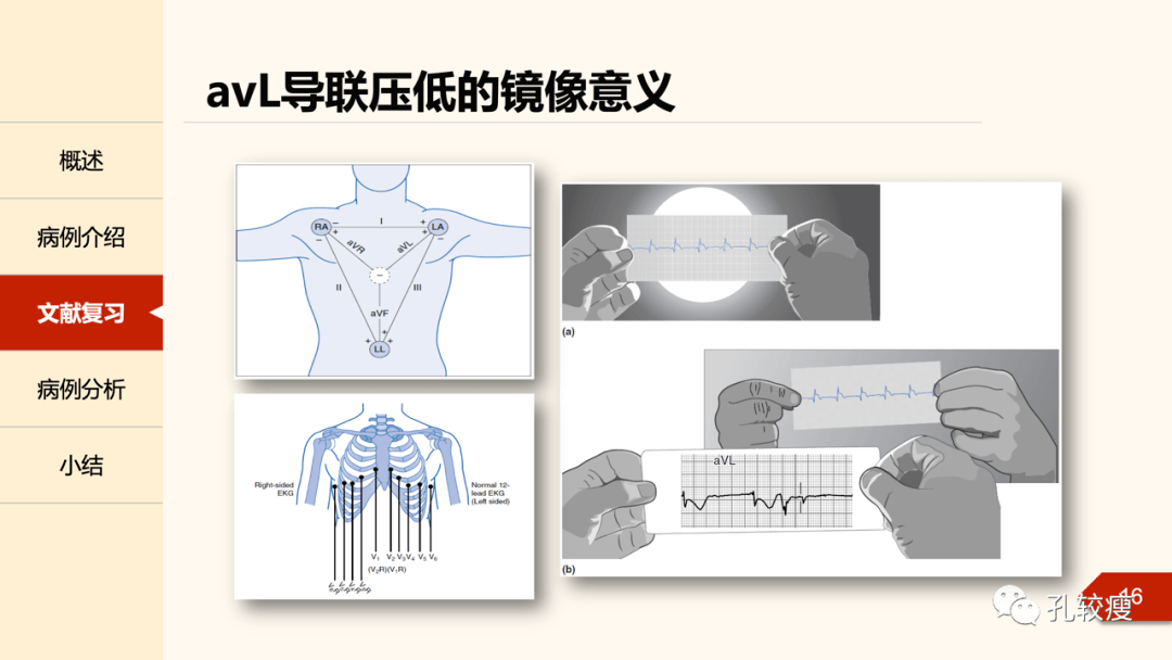 如何巧用avl导联诊断下壁心肌梗死