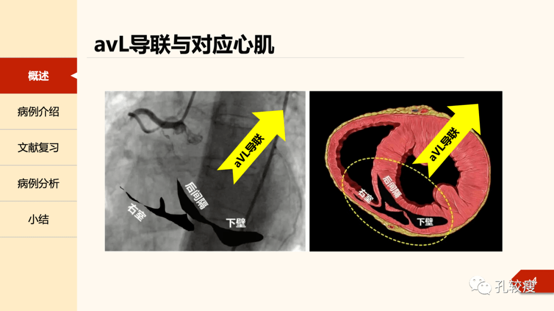 如何巧用avl导联诊断下壁心肌梗死