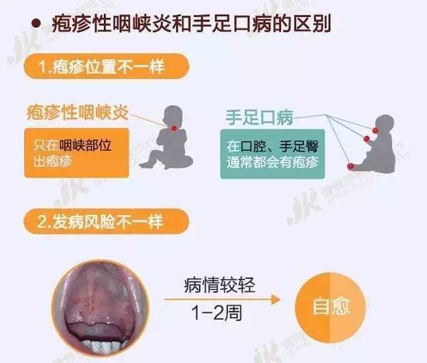 孩子|幼儿疱疹性咽峡炎进入高发期！家里有孩子的一定要注意！