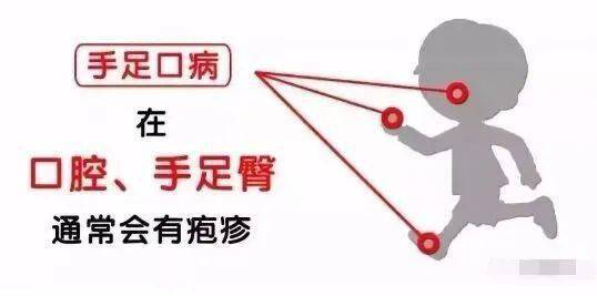孩子|幼儿疱疹性咽峡炎进入高发期！家里有孩子的一定要注意！