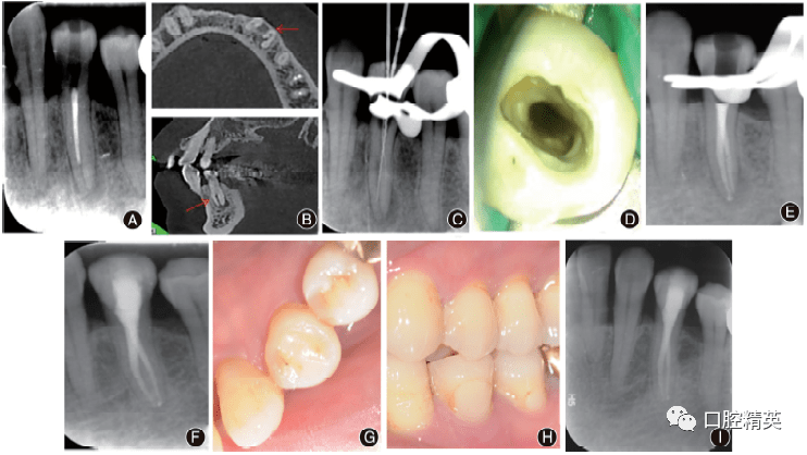 下颌第一前磨牙变异根管的诊断和治疗4例报告