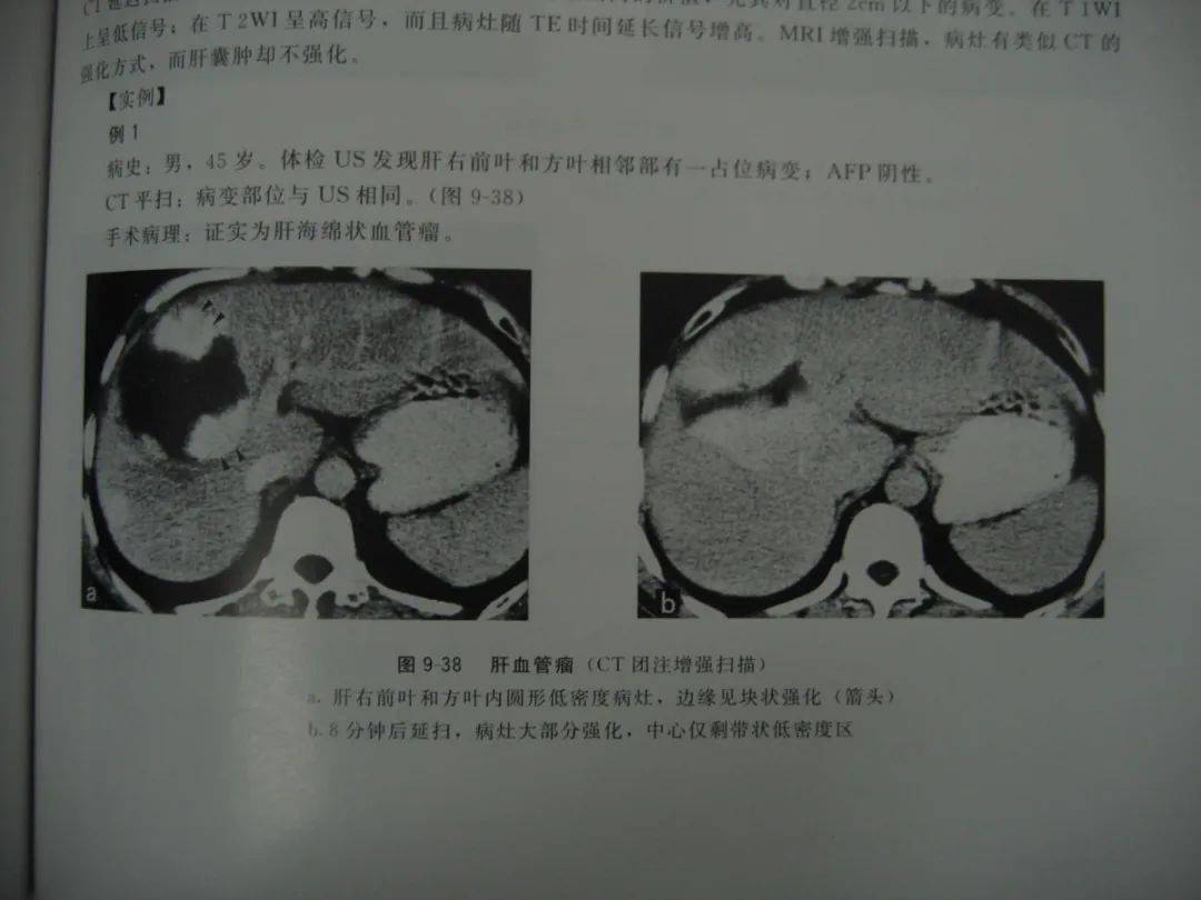 肝占位病变的鉴别诊断