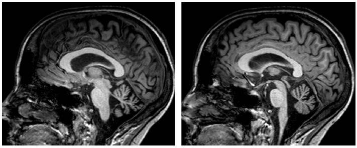 线粒体疾病相关的小脑萎缩.图为头颅mri t1加权序列矢状位图像.