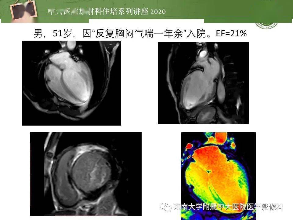 中大放射住培系列讲座非缺血性心肌病的磁共振诊断