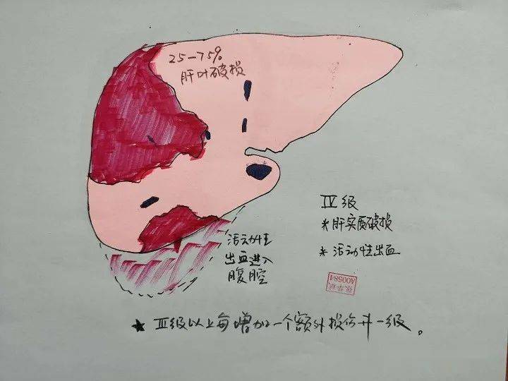 画图aast肝脏破裂伤的分级