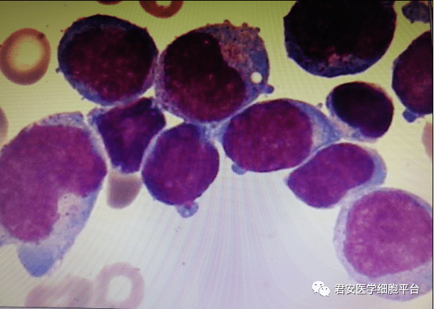 骨髓涂片病态细胞细胞化学染色:pox :阴性;hsd :部分溶解;ce :阴性