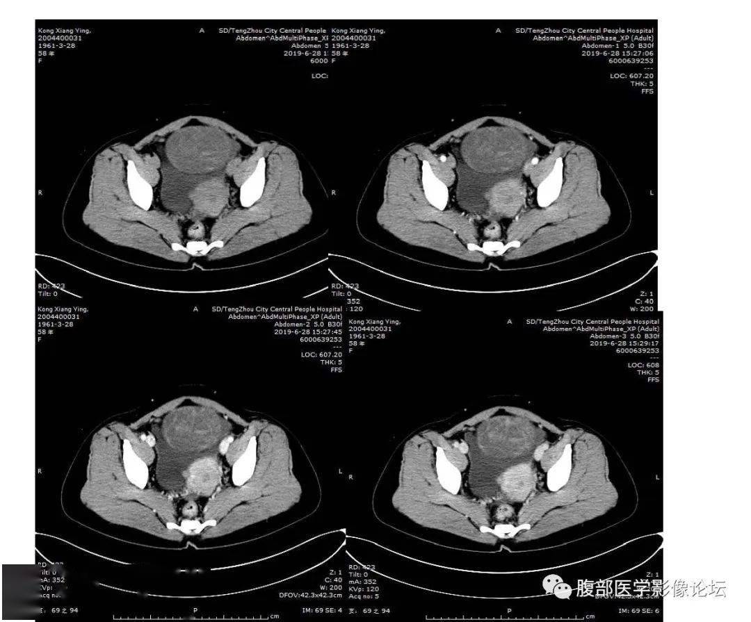 施彪:中年女性,盆腔偏左侧不均质软组织肿块,内见囊变坏死出血,病灶有