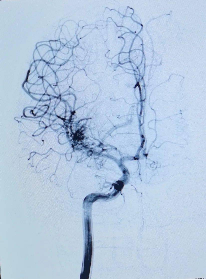 顺利完成了脑血管造影,明确了畸形团的大小及其供血动脉和引流静脉,与