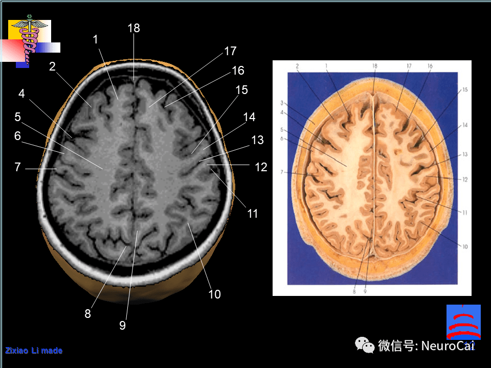 影像解剖脑局部解剖与功能图谱