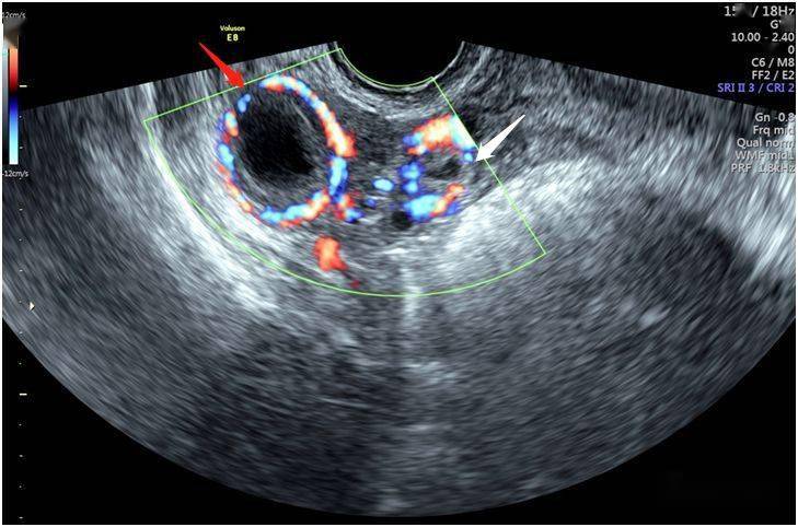 检出宫内妊娠时,要考虑异位妊娠发生的可能!