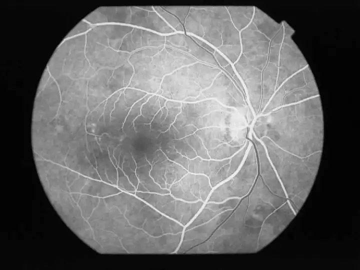 不同眼病的眼底血管荧光造影