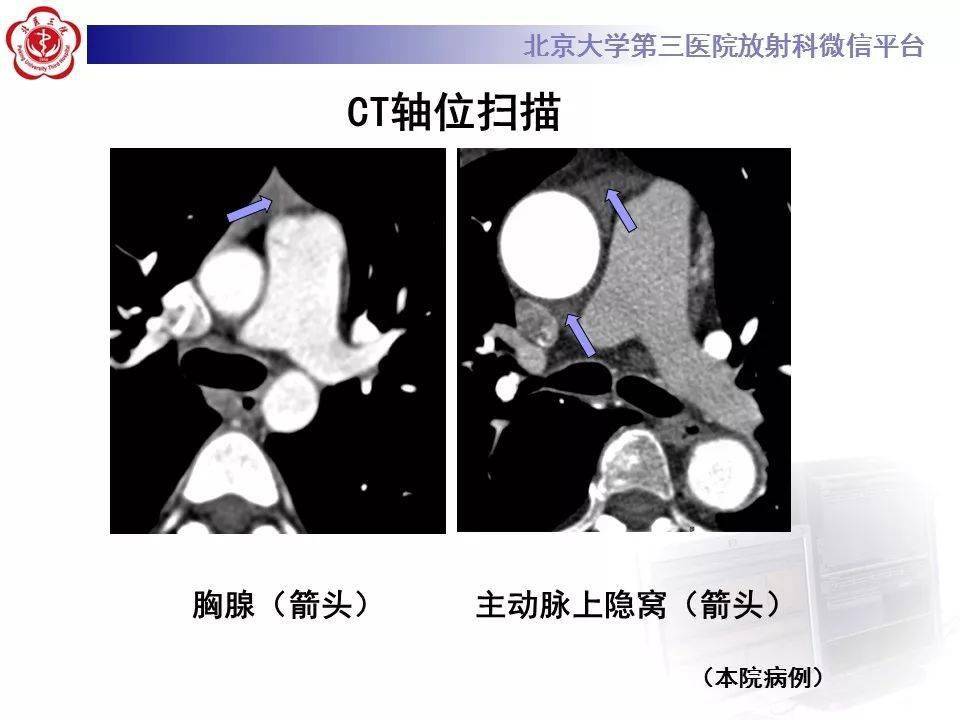 影像精美解剖丨心包窦及心包隐窝解剖,建议收藏!