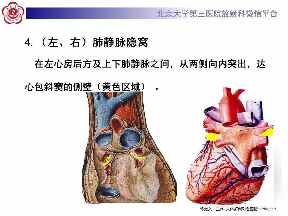 影像精美解剖丨心包窦及心包隐窝解剖建议收藏