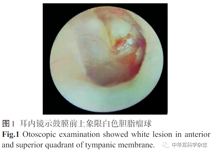 耳内镜下处理先天性中耳胆脂瘤的临床疗效分析