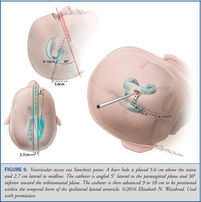 operativeneurosurgery颅骨测量与脑室穿刺