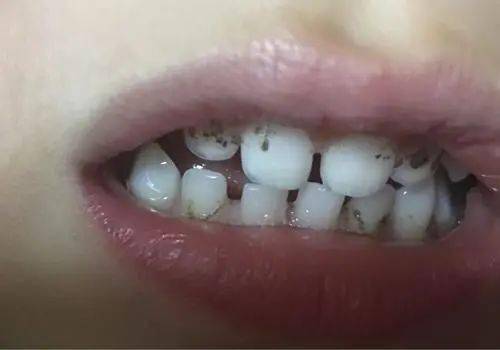 儿童常见的"四大牙齿问题"怎么处理?几岁正畸最合适?_手机搜狐网