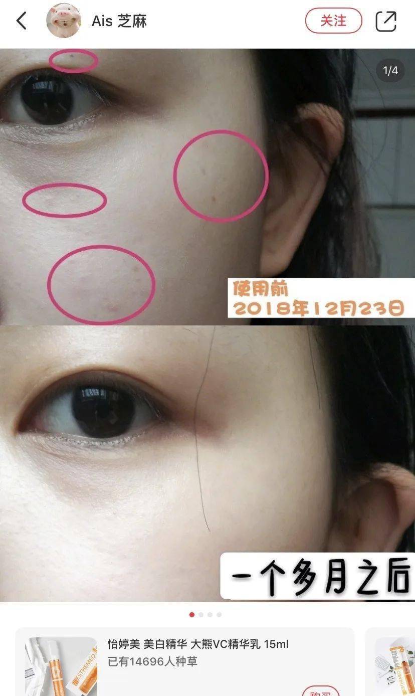 皮肤|用它点一点，痘印、斑点竟然没了，难怪李佳琦都为它疯狂打call！