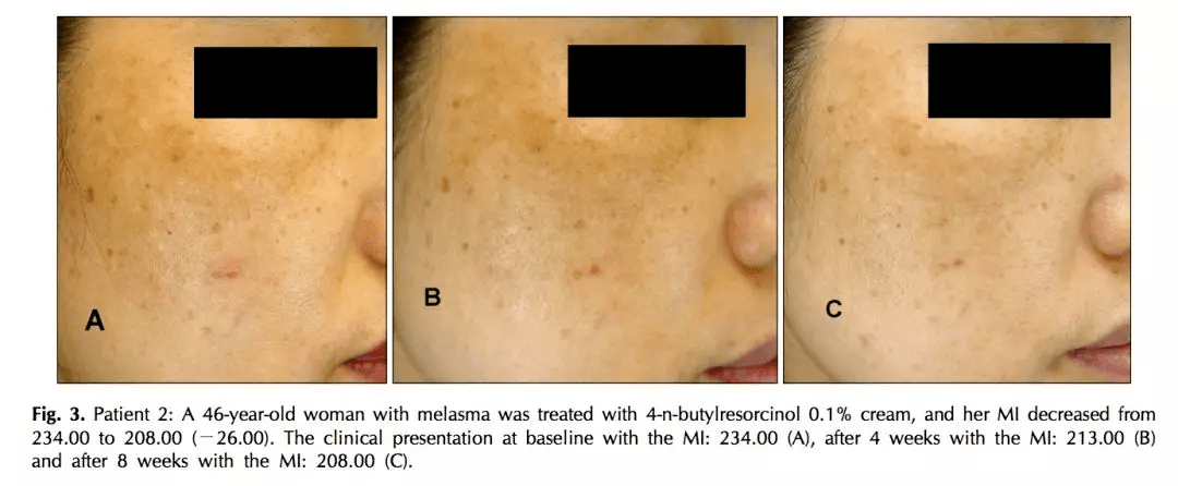 皮肤|用它点一点，痘印、斑点竟然没了，难怪李佳琦都为它疯狂打call！