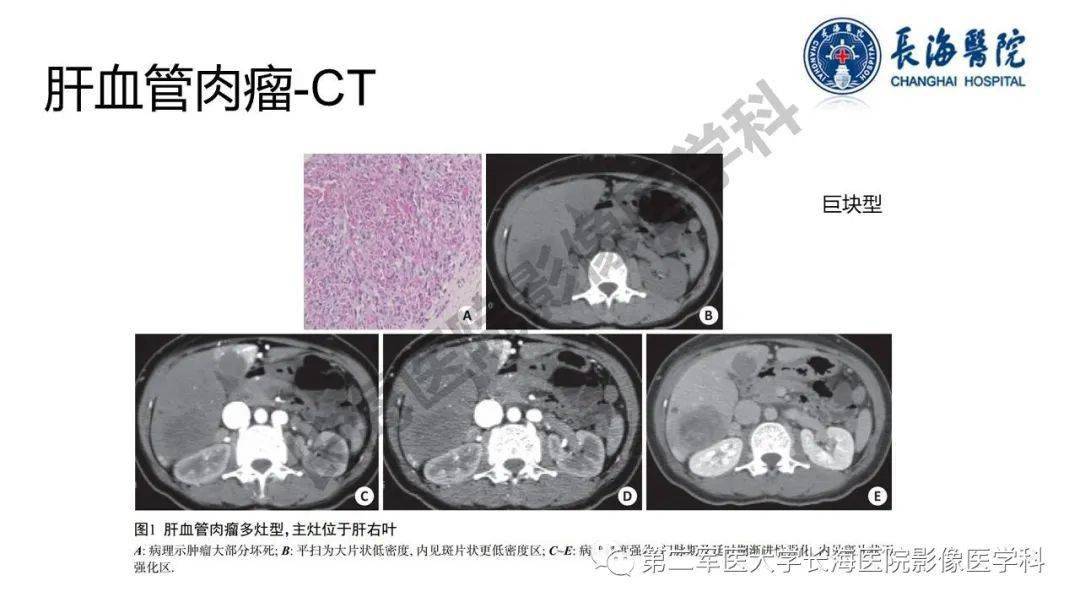 肝脏血管肉瘤影像表现