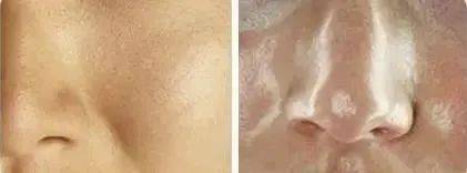 吸铁石|新西兰百年历史“污垢吸铁石”,15分钟告别黑头、粉刺、闭口!