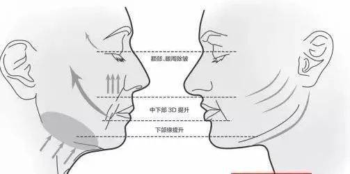 姐姐|乘风破浪的姐姐火了，没想到这些医美项目竟然也火了！