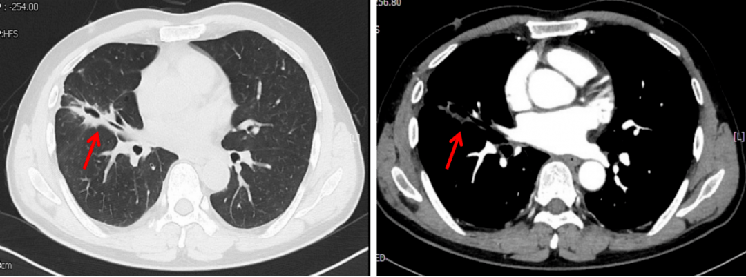 胸部增强ct 来自搜狐网